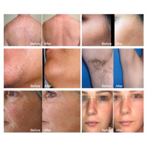 Vertical Two Handles High Power 3 Waves Diode Laser Hair Removal Machine Ice