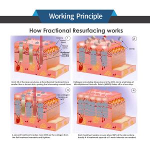 High Speed 10.6um Co2 Fractional Laser Machine Max Scanning Speed Of 12m/S