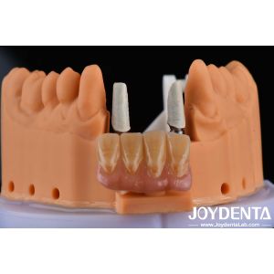 4.5mm Height Finished Abutments Internal Hex Connection Type Compatible With