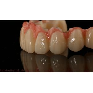 Porcelain All On Four Zirconia Bridge High Esthetics Dental Implant Bridge