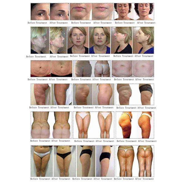 Fat Buring Vacuum Roller Vela Body Shape 360 Slimming RF Face Lifting Body Shaping Machine