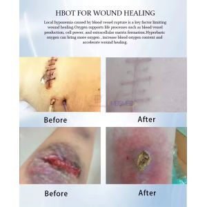 1.3ATAT 1.5ATAT 2.0 ATAT Oxygen Hyperbaric Oxygen Chamber