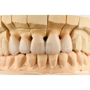 Highly Customizable Layered Zirconia Dental Crowns And Bridges Long Lasting