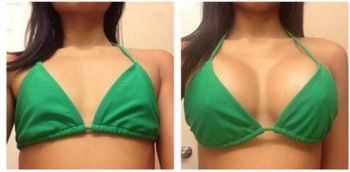 Personal Care 10ml Hyaluronic Acid Breast Filler To Increase Breast Size