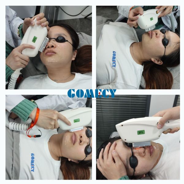Advanced IPL SHR Elight Machine for Customized Hair Removal and Skin Care Solutions