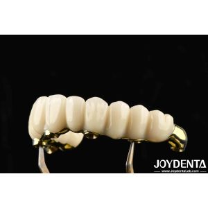 Comfortable To Wear Ti-Bar Zirconia Hybrid Bridge Restores Chewing Function