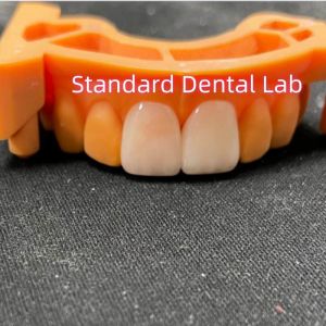 High Colour Stability Ivoclar Emax Laminate Veneers High Translucency