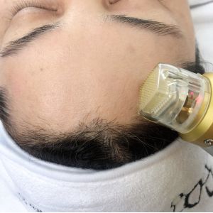 Scar Reduction Microneedling Fractional RF for Acne Scars Skin Resurfacing