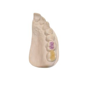 Custom High-Density Custom Dental Ceramics FDA All-Ceramic Crown