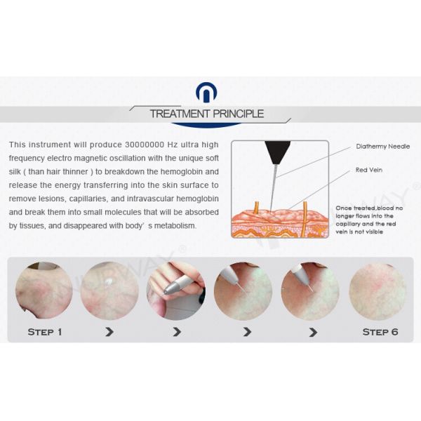 Factory Price Spider Vein Removal Machine / Veins Removal Machine / Facial Vein Removal