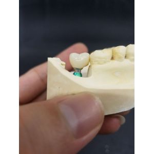 Smooth Surface Biocompatible Zirconia Tooth Crown Easy Maintain