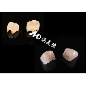 Smooth Hypoallergenic Ceramic Inlays Onlays Custom Fit Stain Resistance High