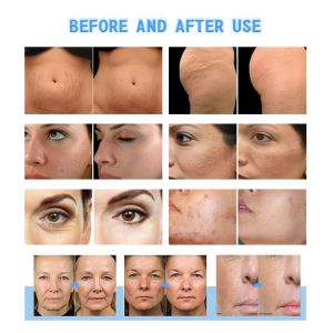 Professional RF Microneedling Machine With RF Radiofrecuent CE approved