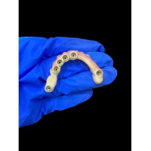 Titanium Abutment and Zirconia Crown Implant Supported Dentures Precision Fit