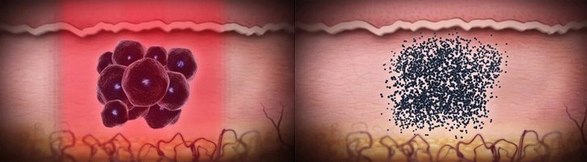 Picosecond q switched nd yag laser picosure q-switched tattoo removal laser machine