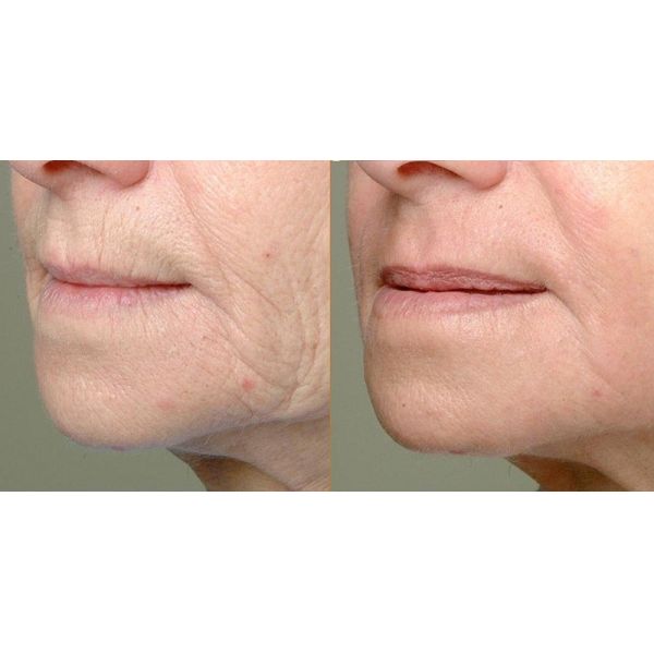 Professional CO2 Fractional Laser Machine For Stretch Marks / Scar Removal