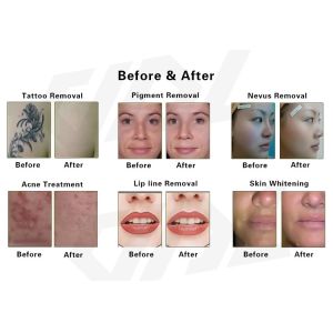 Skin Rejuvenation Pico Laser Picosend Tattoo Removal Machine Carbon Peel Beauty