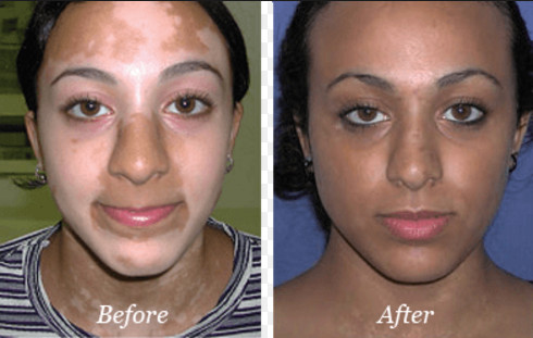 Vitiligo Treatment UVB Light Therapy Machine Phototherapy Lamp with LCD Timer