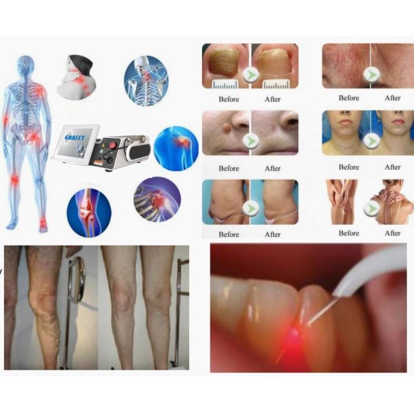 980nm 1470nm Diode Laser Slimming System Nail Fungus Treatment