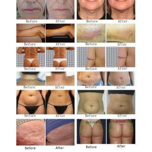 the rotary negative pressure RF slimming Machine for burning fat body shaping