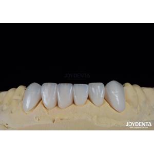 Glossy Surface Texture Feldspathic Veneer Natural Looking Porcelain Veneer