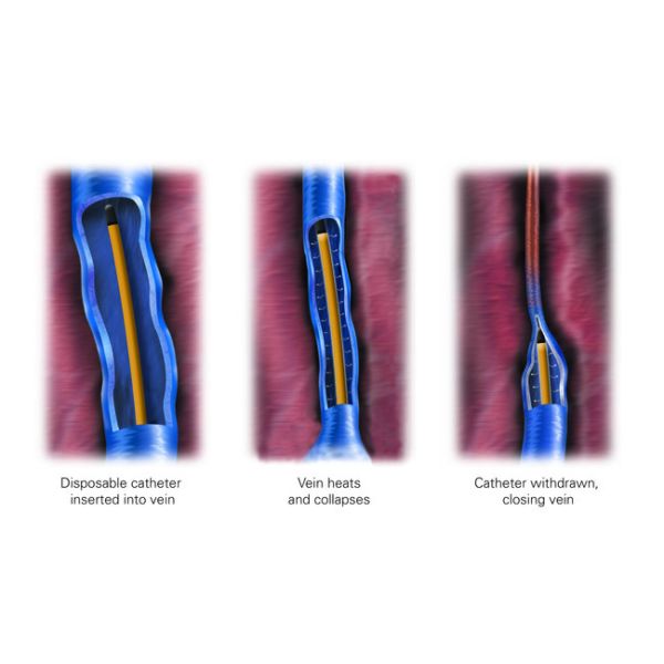 Portable 980nm Medical Diode Laser Treatment Machine For Greater Saphenous Vein