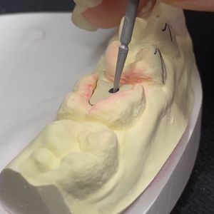 Reinforce Your Restoration with Lock Pink Post Core Technology