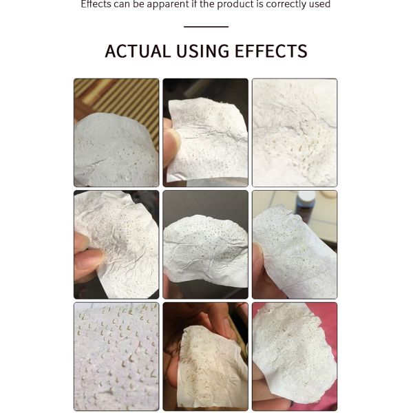 Reduce Growth Of Blackheads And Remove Oil Deep Cleaning White Nose Patch Blackhead Remover